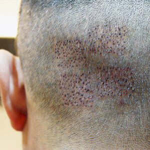 植髮,ARTAS植髮,全自動取髪