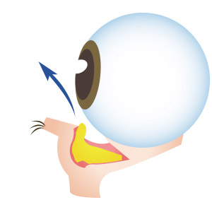 眼袋手術,消除眼袋,眼袋外開,眼袋內開