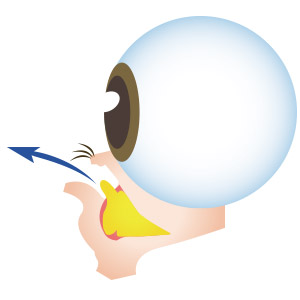 眼袋手術,消除眼袋,眼袋外開,眼袋內開