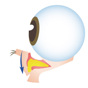 眼袋手術,消除眼袋,眼袋外開,眼袋內開