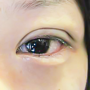 雙眼皮手術,割雙眼皮,縫雙眼皮