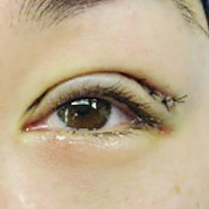 雙眼皮手術,割雙眼皮,縫雙眼皮