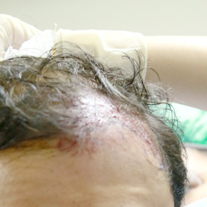 植髮,FUE植髮,寇約翰,半自動取髪