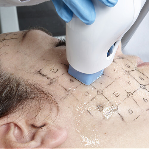 音波拉提,音波拉皮,臉部拉提,電波拉提