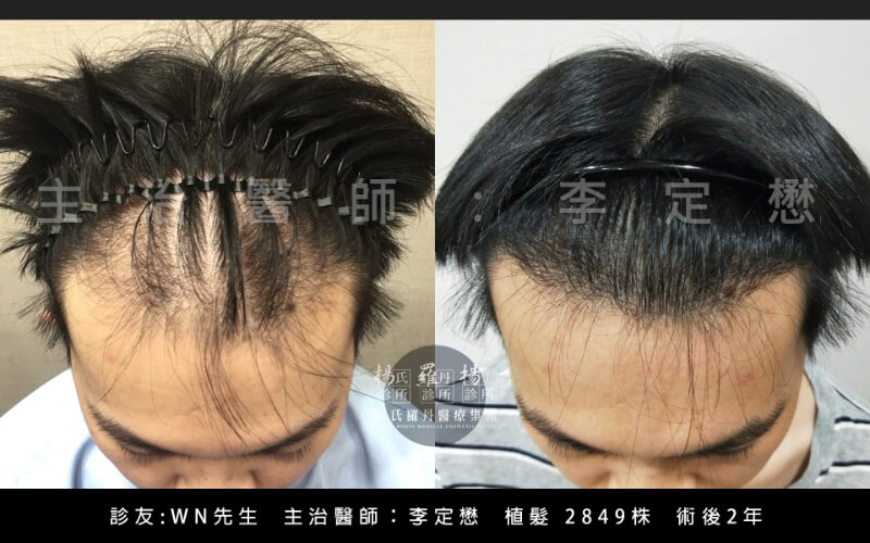 冠頂禿,冠狀區禿,頂部禿,O型禿,圓形禿