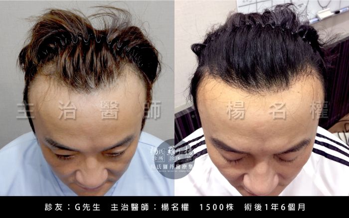 髮際線禿,女生髮際線