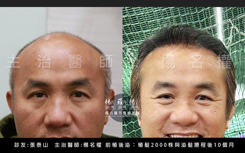 植髮案例分享