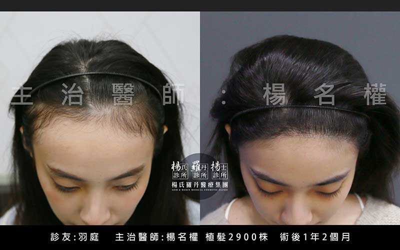 植髮,ARTAS,植髮推薦,羽庭植髮