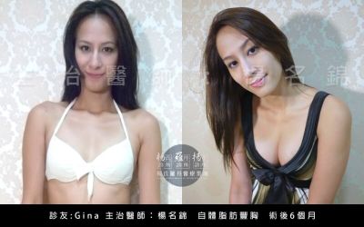 胸部手術案例分享