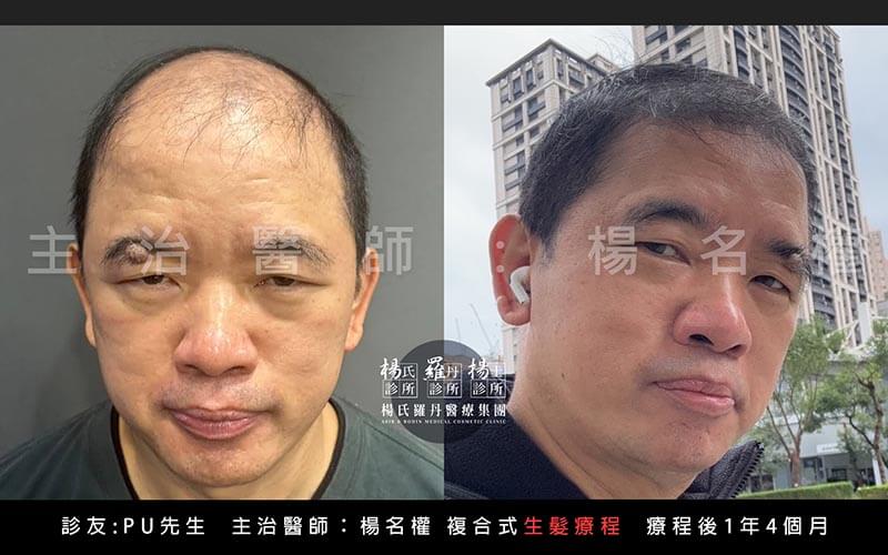 生髮案例分享