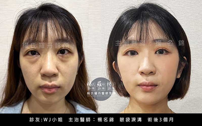 醫美微整形案例分享