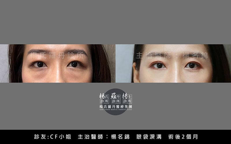 眼整形案例分享