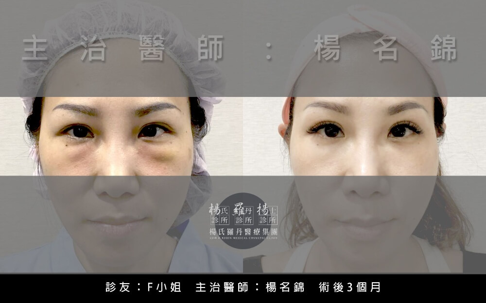 淚溝手術,淚溝玻尿酸,消除淚溝,淚溝手術推薦