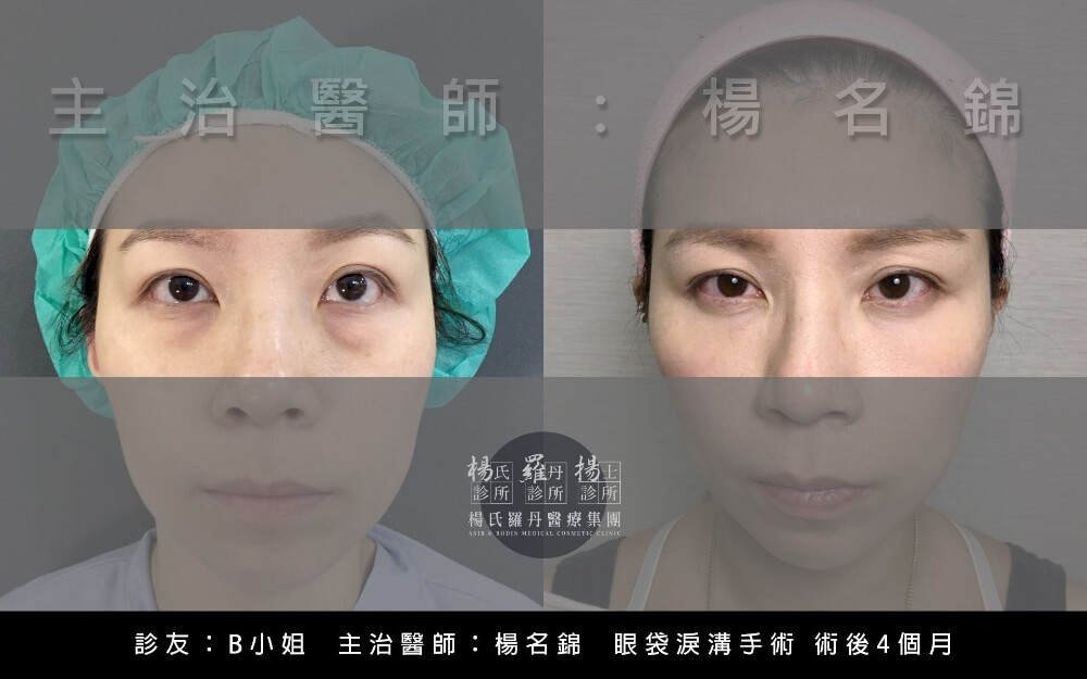 淚溝手術,淚溝玻尿酸,消除淚溝,淚溝手術推薦