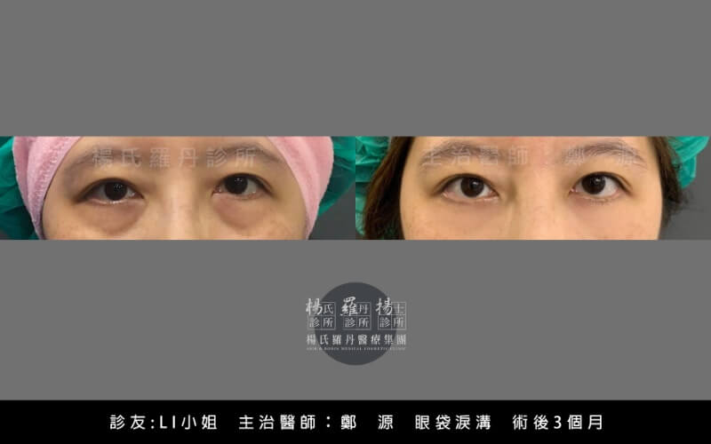 消除眼袋手術費用