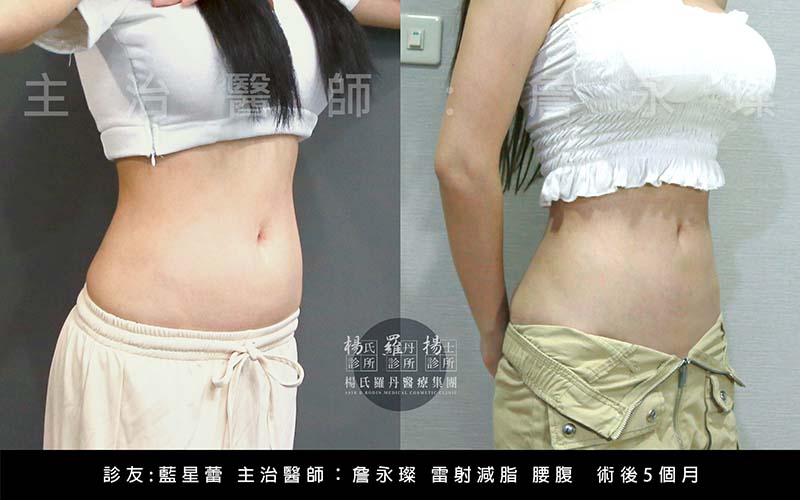 減脂,體雕,雷射減脂,藍星蕾