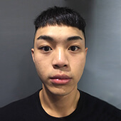 唇型/鼻型調整手術案例心得分享