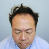 董哥董至成植髮手術案例心得分享