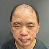 複合式生髮案例心得分享