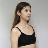 自體脂肪隆乳案例心得分享