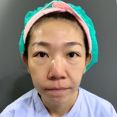消除眼袋淚溝手術案例心得分享