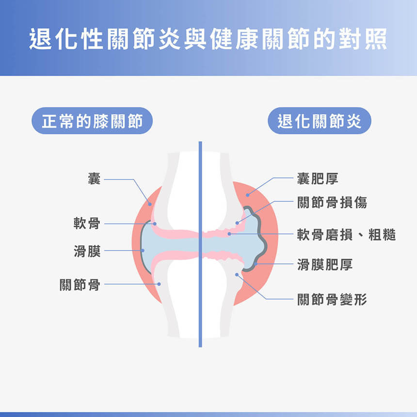 退化性關節炎症狀有哪些?認識膝關節退化原因、治療與保養方法!