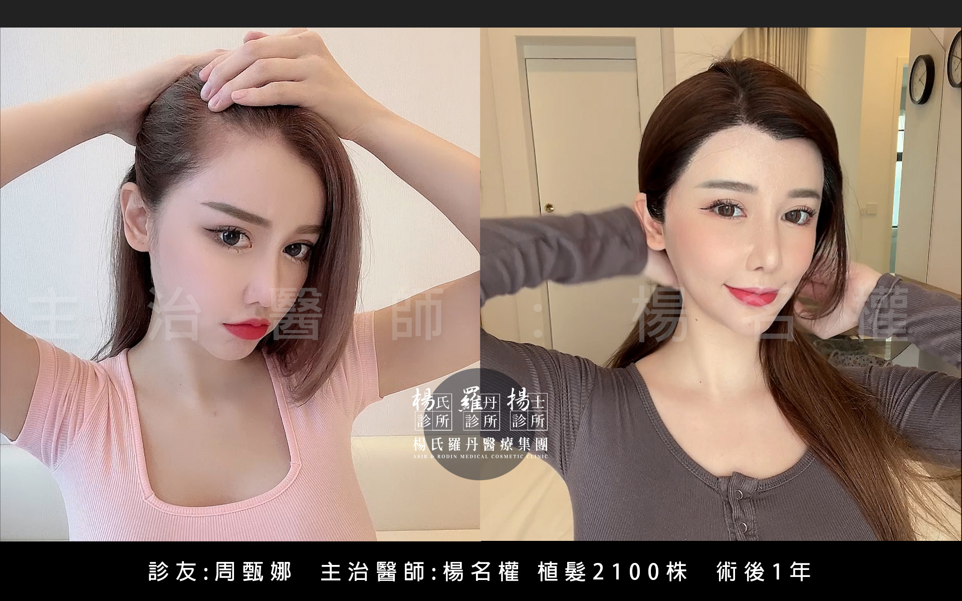 植髮,ARTAS,植髮推薦,周甄娜植髮