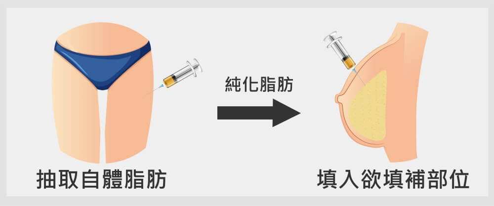 自體脂肪隆乳手術