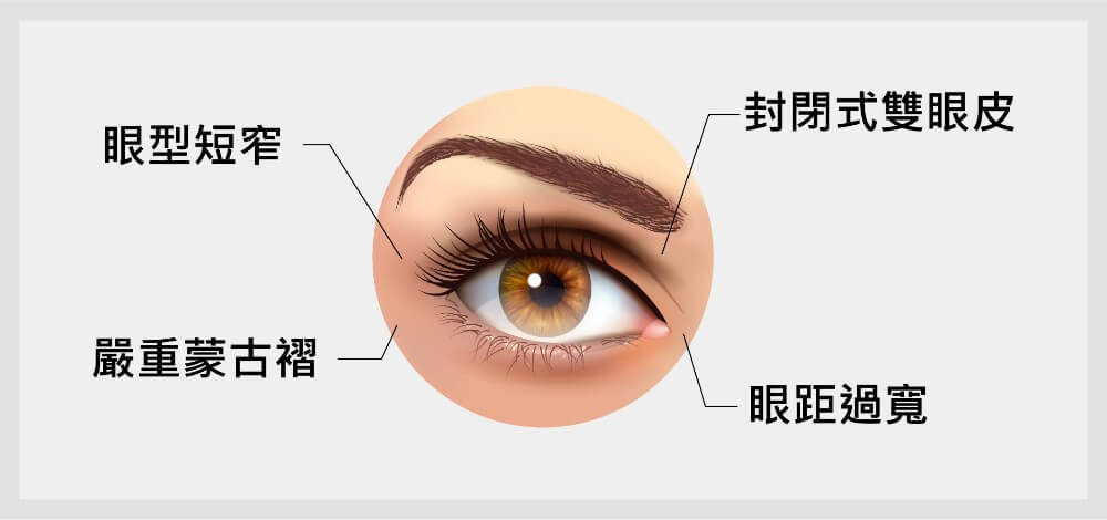 開眼頭方式適合