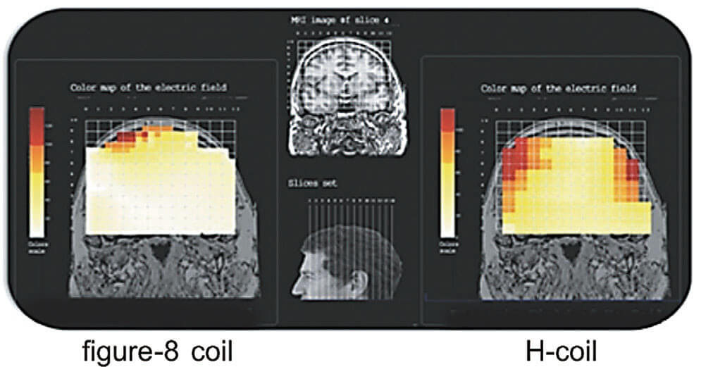 Figure-8 Coil VS. H-Coil比較