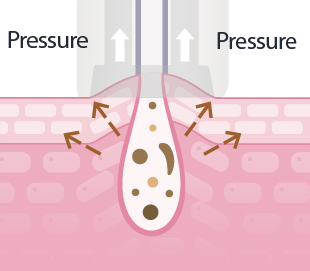 Deuxclair淨透水飛梭,水飛梭,導入,醫美療程