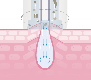 Deuxclair淨透水飛梭,水飛梭,導入,醫美療程