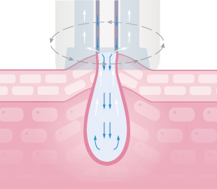 Deuxclair淨透水飛梭,水飛梭,導入,醫美療程