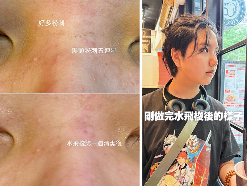 小馬克,Deuxclair淨透水飛梭,水飛梭,導入,醫美療程