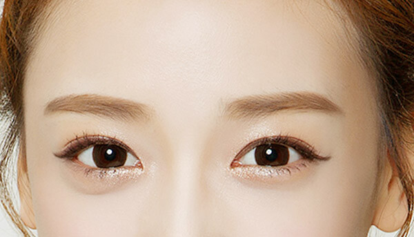 雙眼皮手術,割雙眼皮,縫雙眼皮