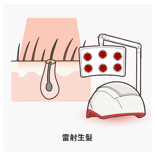 臨床實驗證實，透過650nm波長照射16週後，使用真正雷射帽的診友平均髮量增加43.2％