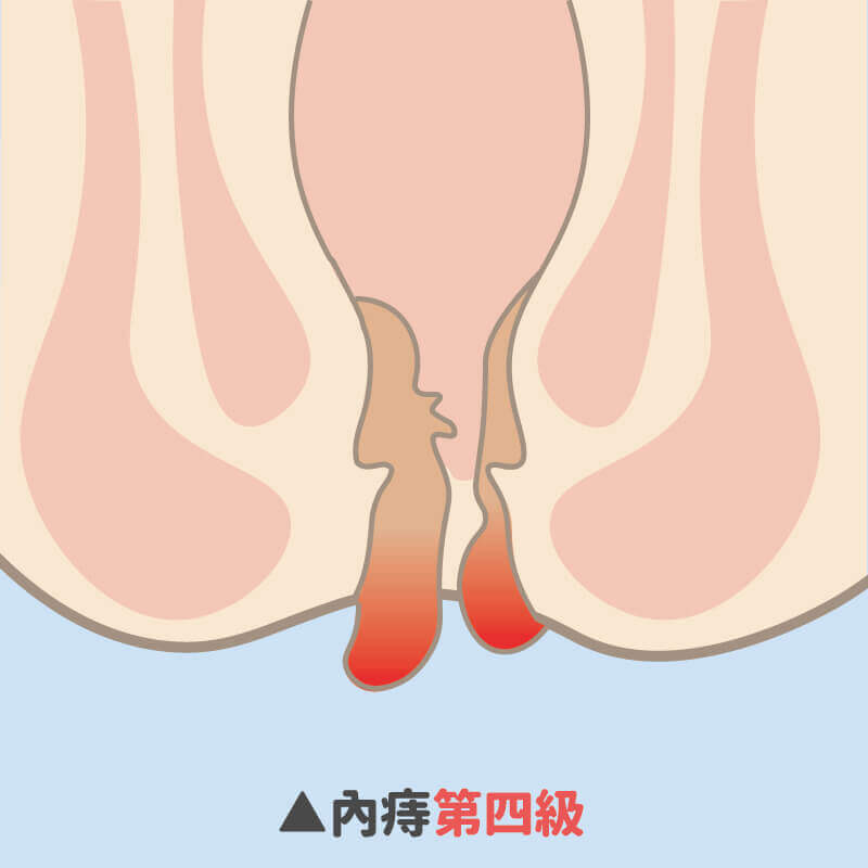 常見痔瘡症狀、分類-內痔第四級