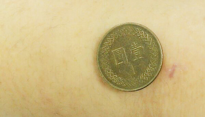 體雕,減脂,雷射減脂