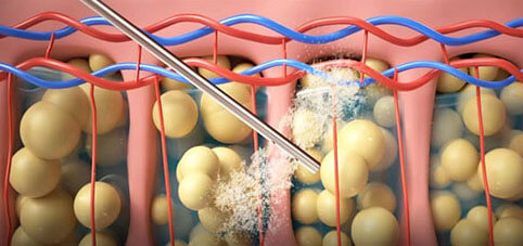 #LSSA音浪脂雕作用原理,減脂,體雕,減脂手術