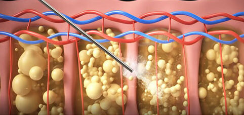 #LSSA音浪脂雕作用原理,減脂,體雕,減脂手術