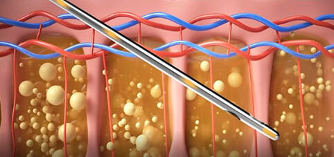 #LSSA音浪脂雕作用原理,減脂,體雕,減脂手術