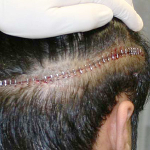 植髮,FUT植髮,切頭皮