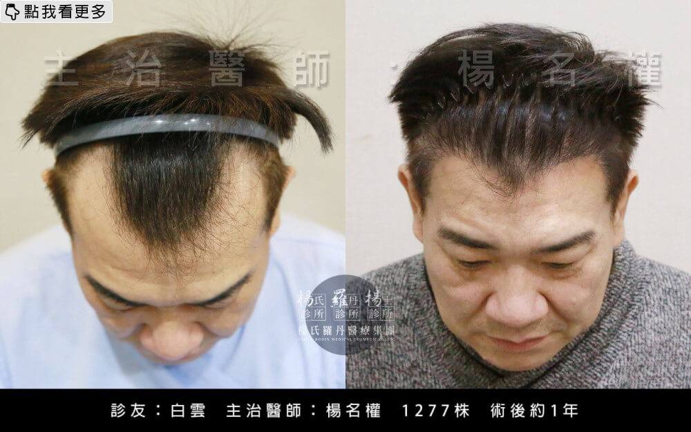 白雲禿髮,M型禿治療生髮