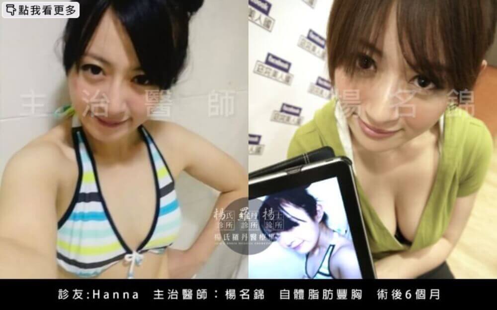 隆乳,Hanna,隆乳推薦,自體脂肪隆乳