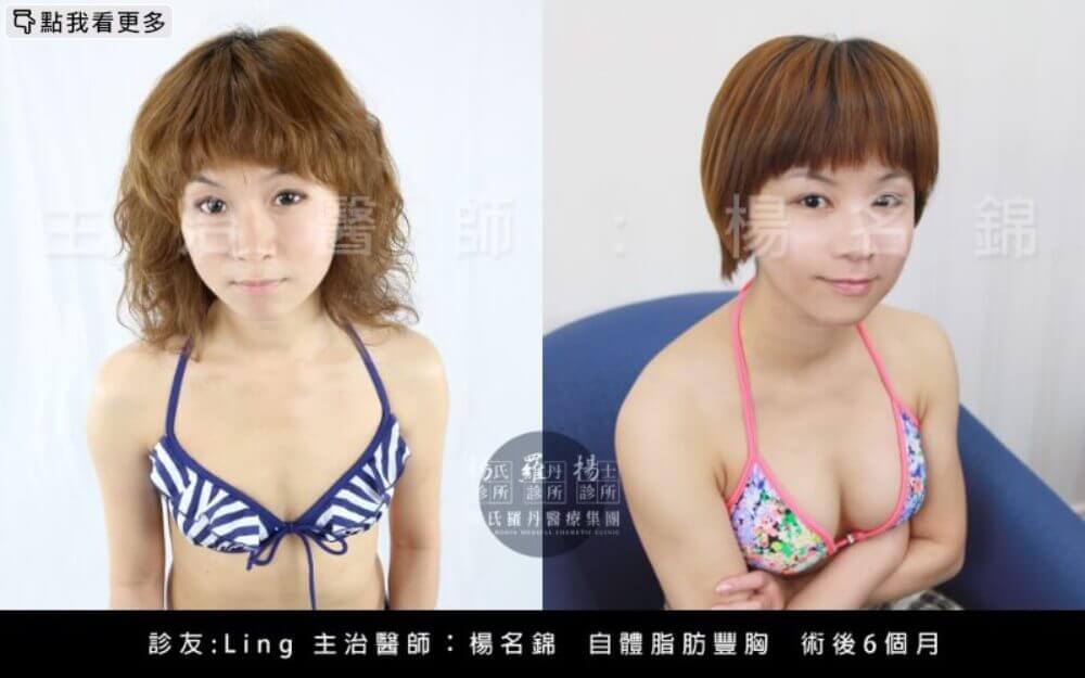 隆乳,Elena,隆乳推薦,自體脂肪隆乳