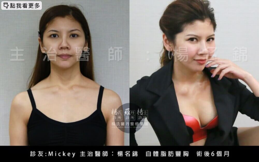 隆乳,霨斯,隆乳推薦,自體脂肪隆乳