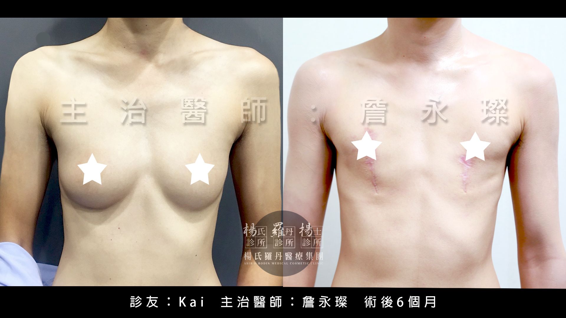 Kai,縮胸手術,平胸手術