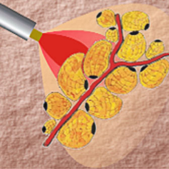 體雕,減脂,雷射減脂