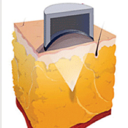 體雕,減脂,雷射減脂,超音波溶脂