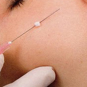 音波拉提,音波拉皮,3D微絲拉提